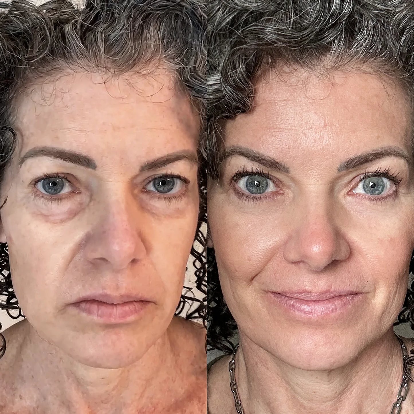 Omniskin™ LED Under-Eye Repair