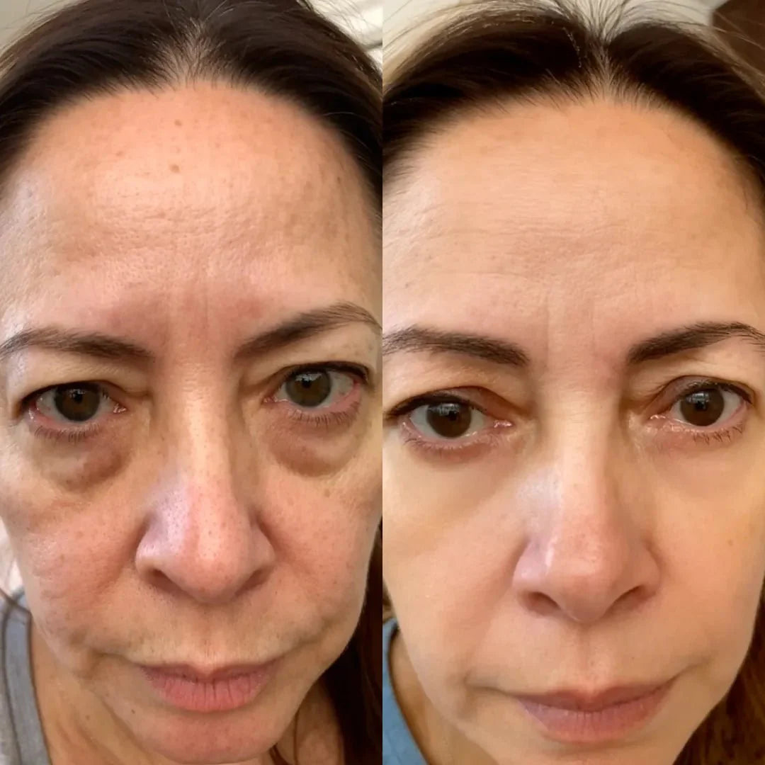 Omniskin™ LED Under-Eye Repair